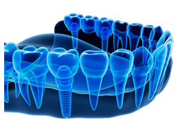 3d technologies braces