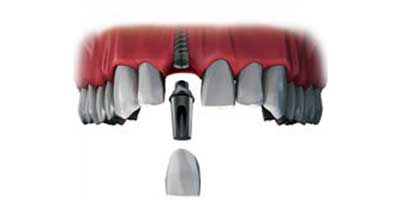 Dental implant
